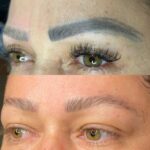 Antes e depois da despigmentação a laser (2)