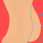 abdominoplastia